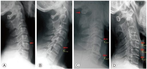 a,b) Mono segment spondylosis at C5-6 c) Two-segment spondylosis at C4-5 and C6-7 d) Three-segment spondylosis at C4-5, C5-6, and C6-7