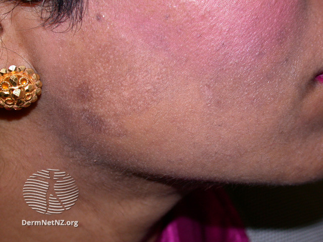 File:Postinflammatory pigmentation (DermNet NZ colour-hyperpig2).jpg