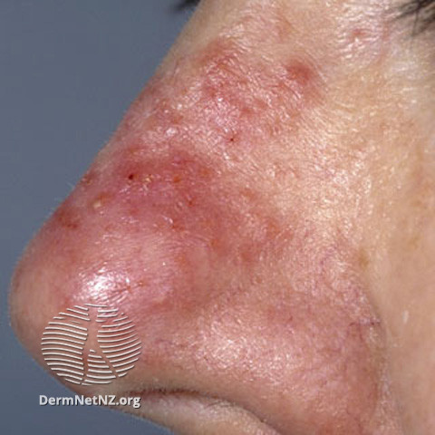 Rosacea (DermNet NZ acne-red-face-3645).jpg