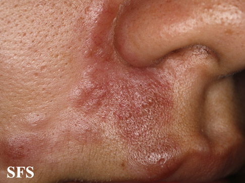 File:Sarcoidosis (Dermatology Atlas 27).jpg