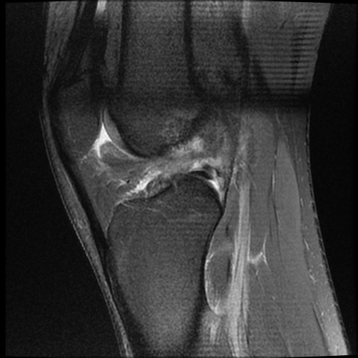 File:ACL acute full thickness tear - deep lateral femoral sulcus sign (Radiopaedia 38594-40740 Sagittal PD fat sat 13).jpg