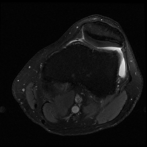 File:ACL and meniscal tears (Radiopaedia 79604-92797 Axial PD fat sat 8).jpg
