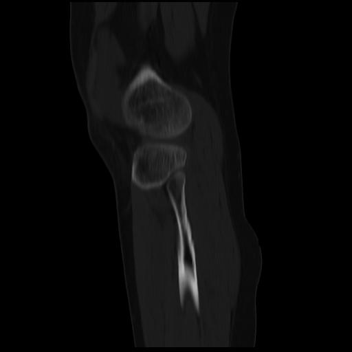 File:ACL avulsion fracture (Radiopaedia 33833-34994 Sagittal bone window 10).jpg
