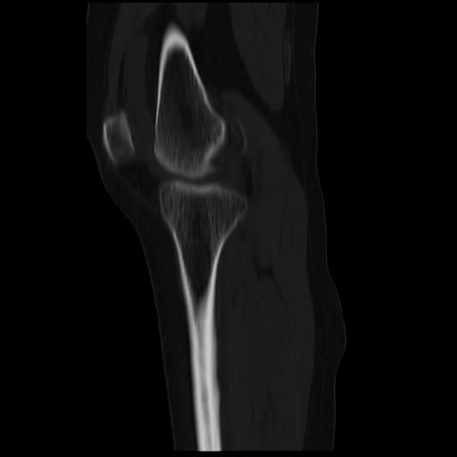 File:ACL avulsion fracture (Radiopaedia 33833-34994 Sagittal bone window 29).jpg