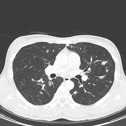 AIDS-related Kaposi sarcoma (Radiopaedia 85247-100811 Axial lung window 78).jpg