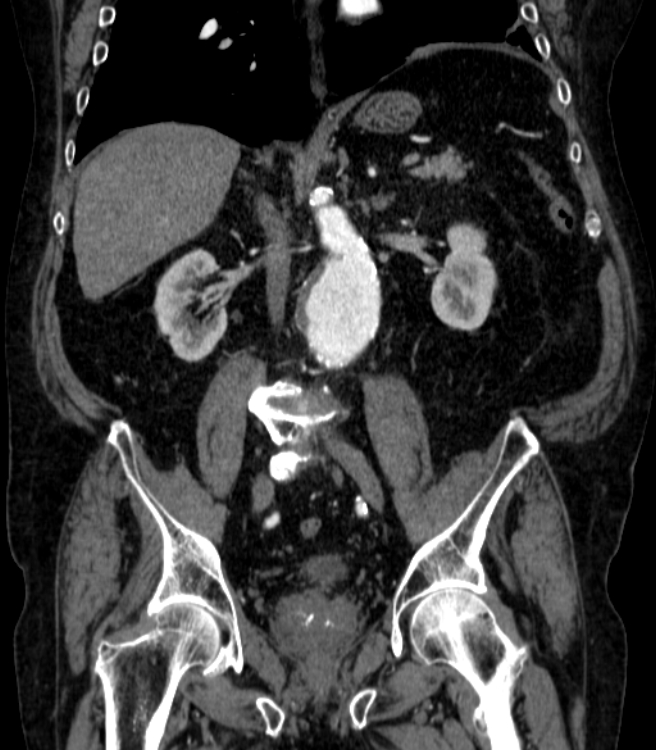 Abdominal aortic aneurysm (Radiopaedia 25855-26001 Coronal C+ arterial phase 39).jpg