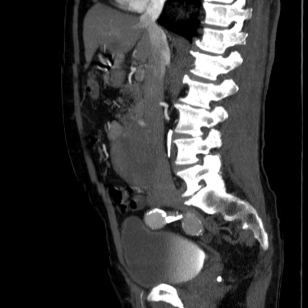 Abdominal aortic aneurysm (Radiopaedia 29248-29660 Sagittal C+ arterial phase 23).jpg
