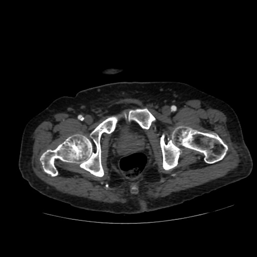 File:Abdominal aortic aneurysm (Radiopaedia 57318-64259 Axial C+ arterial phase 75).jpg