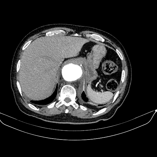 Abdominal aortic aneurysm (Radiopaedia 67117-76452 Axial C+ arterial phase 25).jpg