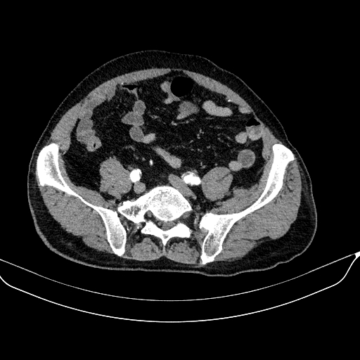 Abdominal aortic aneurysm (Radiopaedia 67117-76452 Axial C+ arterial phase 99).jpg