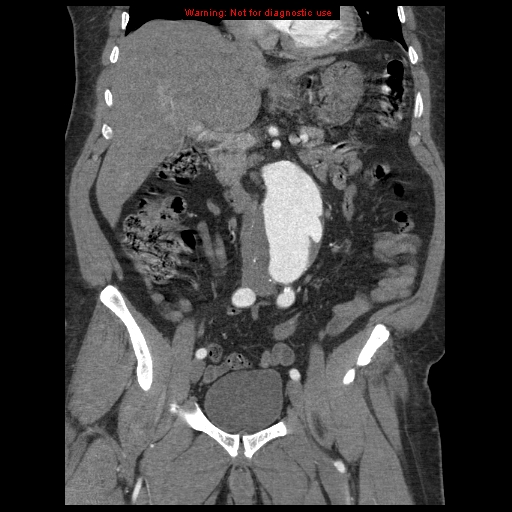 File:Abdominal aortic aneurysm (Radiopaedia 8190-9038 Coronal C+ arterial phase 56).jpg