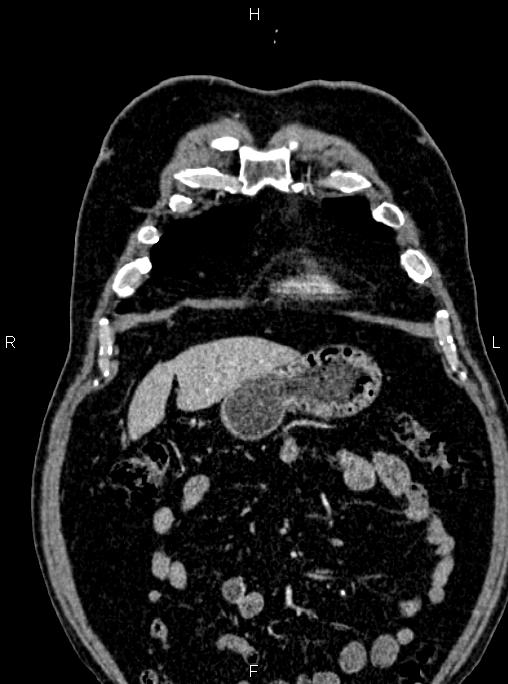 Abdominal aortic aneurysm (Radiopaedia 83094-97462 Coronal renal cortical phase 23).jpg