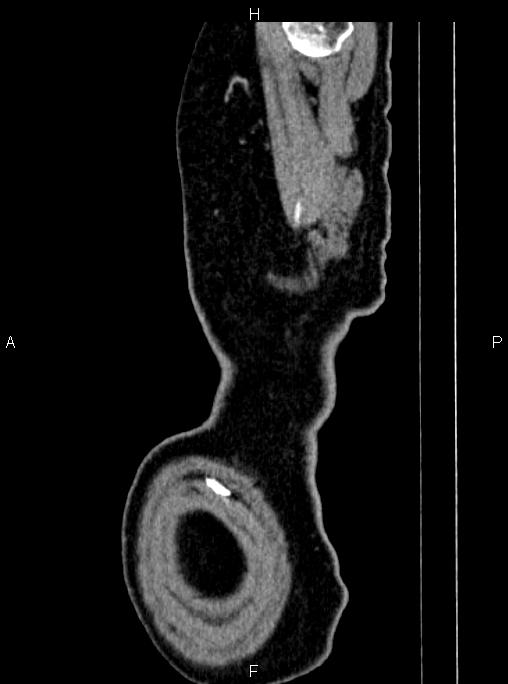 Abdominal aortic aneurysm (Radiopaedia 83094-97462 Sagittal renal cortical phase 5).jpg