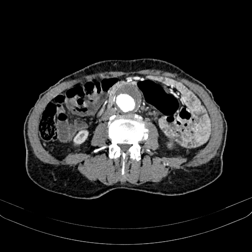 Abdominal aortic aneurysm (Radiopaedia 83581-98689 Axial C+ arterial phase 65).jpg