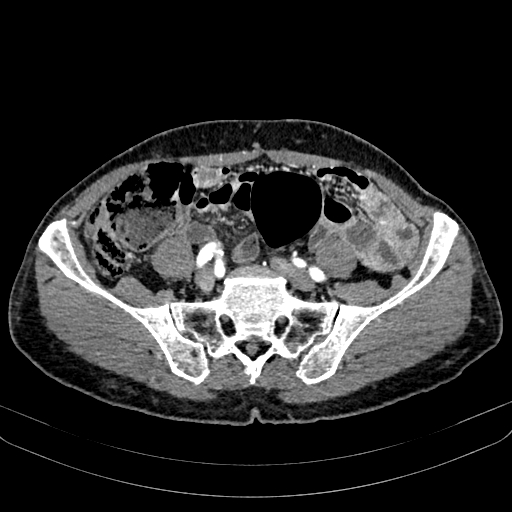 Abdominal aortic aneurysm (Radiopaedia 83581-98689 Axial C+ arterial phase 86).jpg