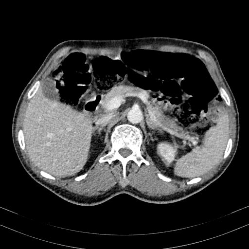 Abdominal aortic aneurysm (Radiopaedia 83581-98689 Axial C+ portal venous phase 35).jpg