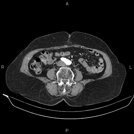 File:Abdominal aortic aneurysm (Radiopaedia 85063-100606 Axial C+ arterial phase 46).jpg