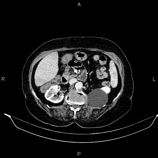 File:Abdominal aortic aneurysm (Radiopaedia 85063-100606 Axial C+ portal venous phase 37).jpg