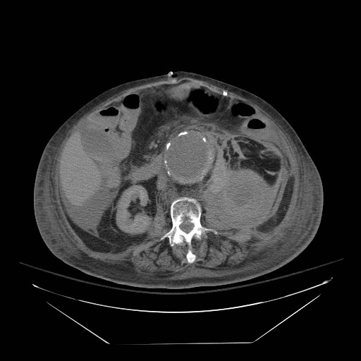 Abdominal aortic aneurysm - impending rupture (Radiopaedia 19233-19247 Axial non-contrast 86).jpg