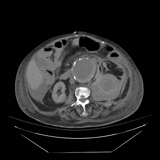 Abdominal aortic aneurysm - impending rupture (Radiopaedia 19233-19247 Axial non-contrast 88).jpg