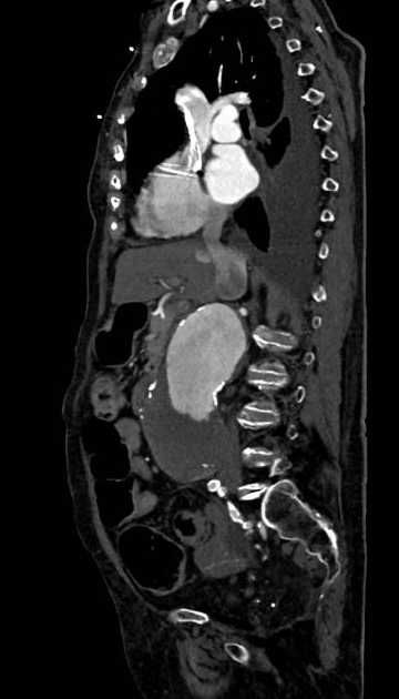 Abdominal aortic aneurysm with thrombus fissuration (Radiopaedia 73192-83919 Sagittal C+ arterial phase 82).jpg