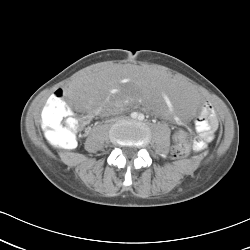 Abdominal desmoid tumor (Radiopaedia 41007-43740 Axial C+ portal venous phase 40).png