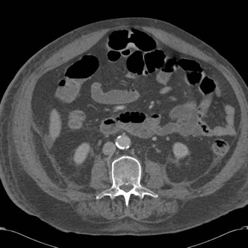 Abdominal hematoma (Radiopaedia 33614-34715 Axial C+ portal venous phase 65).png