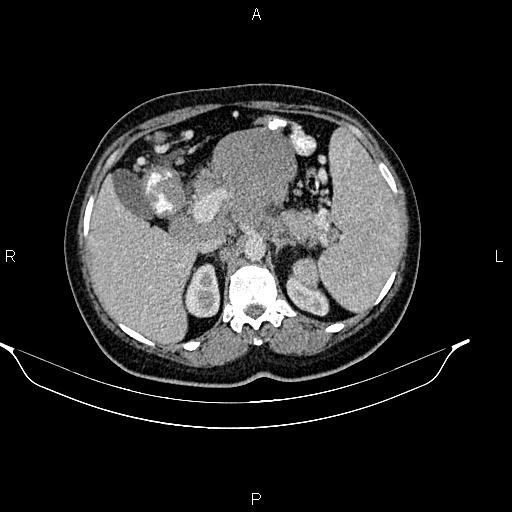 Abdominal lymphoma with sandwich sign (Radiopaedia 84378-99704 Axial C+ portal venous phase 18).jpg