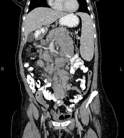 Abdominal lymphoma with sandwich sign (Radiopaedia 84378-99704 Coronal C+ portal venous phase 18).jpg