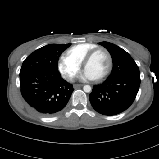 File:Abdominal multi-trauma - devascularised kidney and liver, spleen and pancreatic lacerations (Radiopaedia 34984-36486 Axial C+ arterial phase 57).png