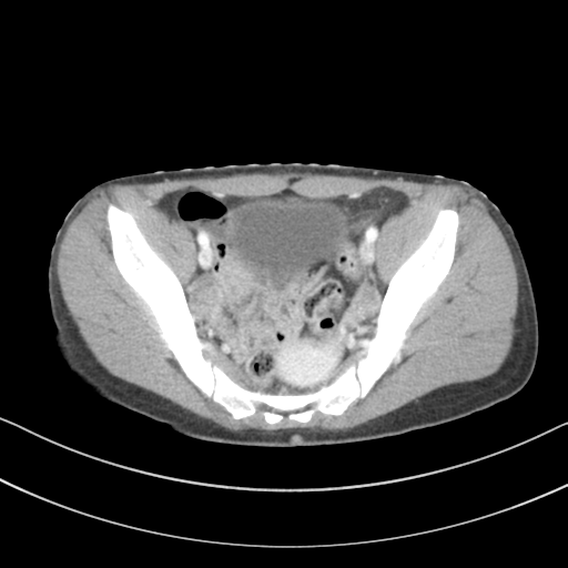 Abdominal multi-trauma - devascularised kidney and liver, spleen and pancreatic lacerations (Radiopaedia 34984-36486 Axial C+ portal venous phase 69).png