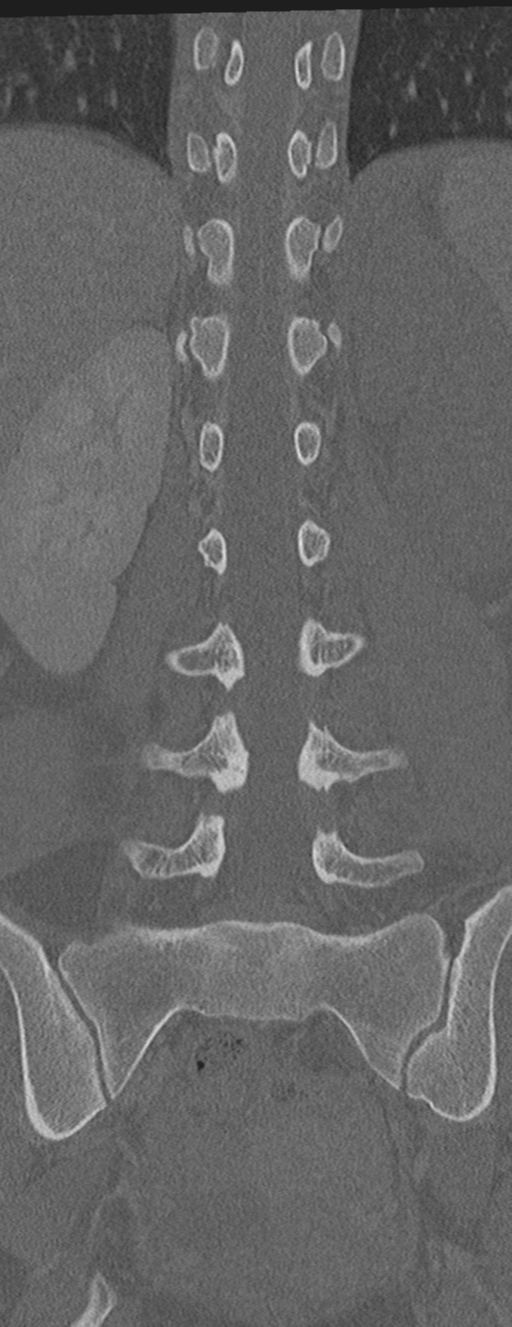 Abdominal multi-trauma - devascularised kidney and liver, spleen and pancreatic lacerations (Radiopaedia 34984-36486 Coronal bone window 41).png
