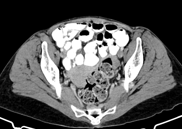 Abdominal wall and retroperitoneal tuberculosis (Radiopaedia 88137-104729 Axial C+ portal venous phase 159).jpg