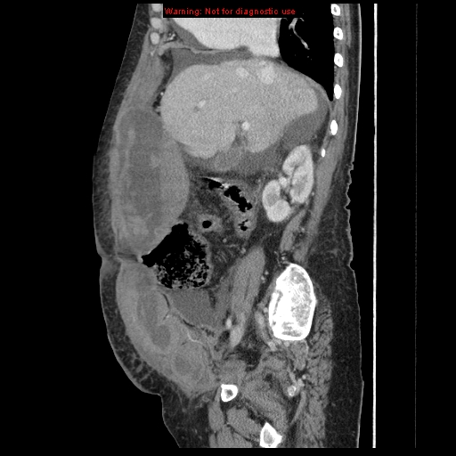 Abdominal wall hematoma (Radiopaedia 9427-10112 Sagittal C+ portal venous phase 70).jpg