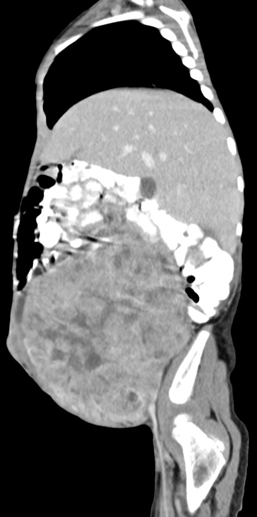 Abdominopelvic rhabdomyosarcoma (Radiopaedia 78356-90984 Sagittal C+ portal venous phase 73).jpg