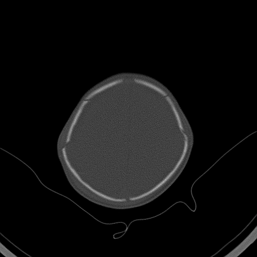 File:Accessory intraparietal suture (Radiopaedia 50584-56020 Axial bone window 38).jpg