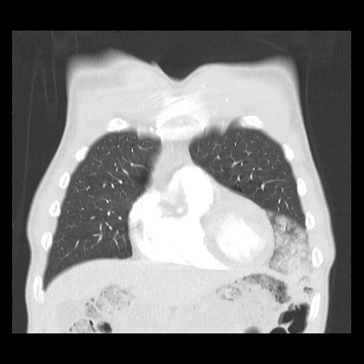 Accessory left horizontal fissure with lingular pneumonia (Radiopaedia 53763-59843 Coronal lung window 12).jpg