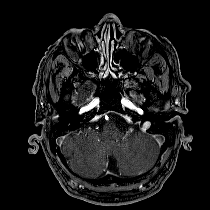 Accessory middle cerebral artery (Radiopaedia 73114-83828 Axial MRA 26).jpg