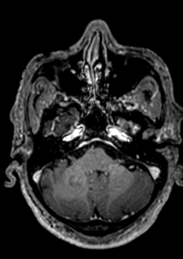 File:Accessory middle cerebral artery (Radiopaedia 73114-83828 Axial T1 C+ 134).jpg