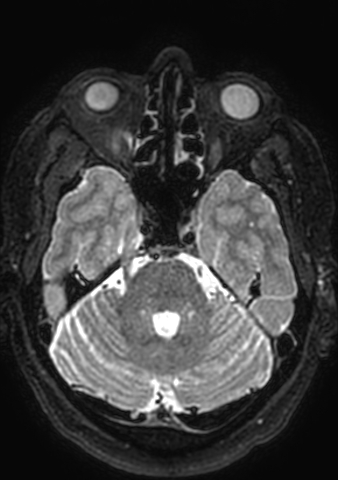 Accessory middle cerebral artery (Radiopaedia 73114-83828 Axial T2 150).jpg