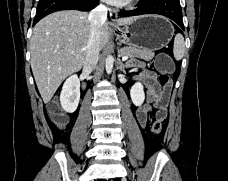 Accessory right inferior hepatic vein (Radiopaedia 75207-86305 Coronal C+ portal venous phase 35).jpg