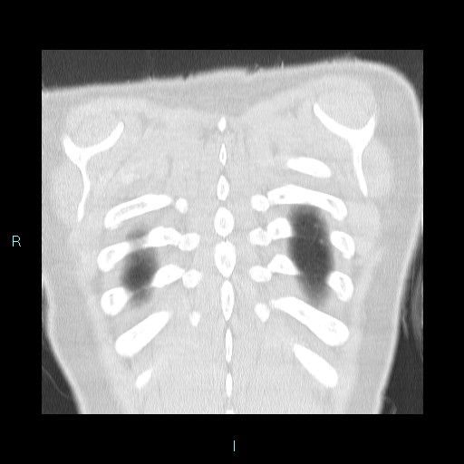 Accidental foreign body aspiration (seamstress needle) (Radiopaedia 77740-89983 Coronal lung window 2).jpg