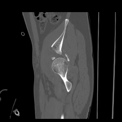 Acetabular and ilial fractures (Radiopaedia 59084-66378 Sagittal bone window 21).jpg