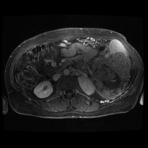 Acinar cell carcinoma of the pancreas (Radiopaedia 75442-86668 Axial T1 C+ fat sat 37).jpg