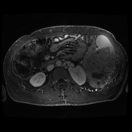 Acinar cell carcinoma of the pancreas (Radiopaedia 75442-86668 D 31).jpg