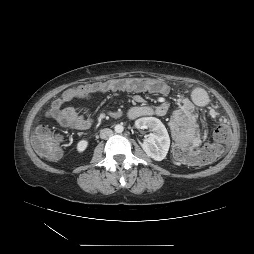 Acinar cell carcinoma of the pancreas (Radiopaedia 75442-86669 Axial C+ portal venous phase 75).jpg