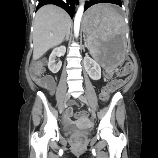 Acinar cell carcinoma of the pancreas (Radiopaedia 75442-86669 Coronal C+ portal venous phase 76).jpg
