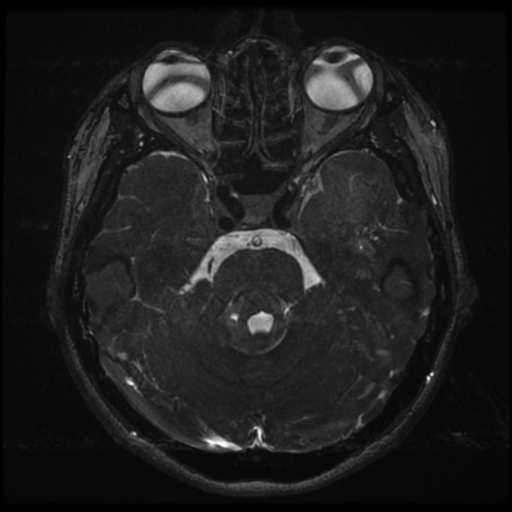 Acoustic neuroma (Radiopaedia 34049-35283 Axial 76).png