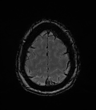 Acoustic schwannoma (Radiopaedia 50846-56358 Axial SWI 82).png