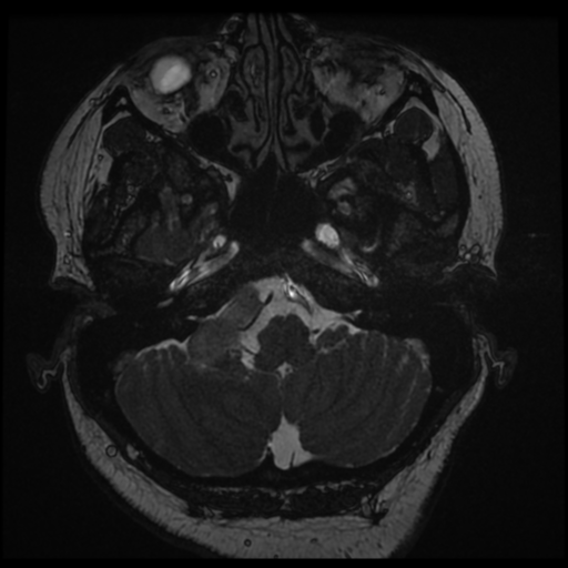 Acoustic schwannoma (Radiopaedia 57574-64536 Axial T2 14).png